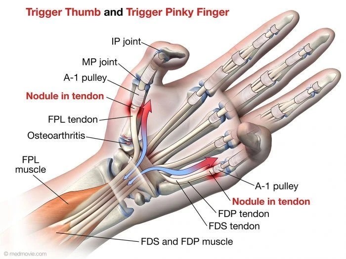 Finger flexor trigger orthobullets pulley system pulleys hand tendon fingers sheath ring topic rauf introduction upload