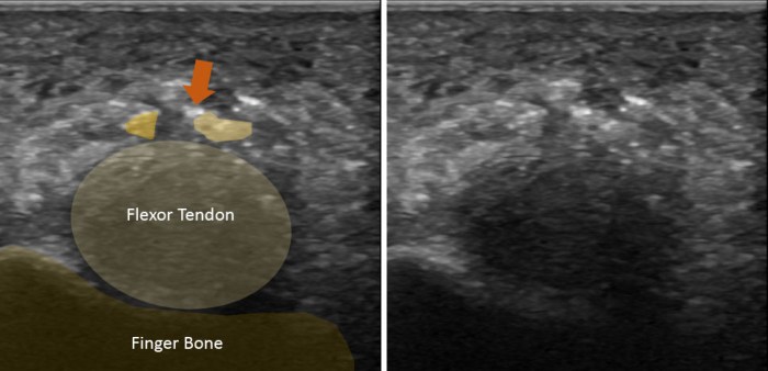 Pulley a1 release percutaneous versus prospective trigger technique study open after thumb