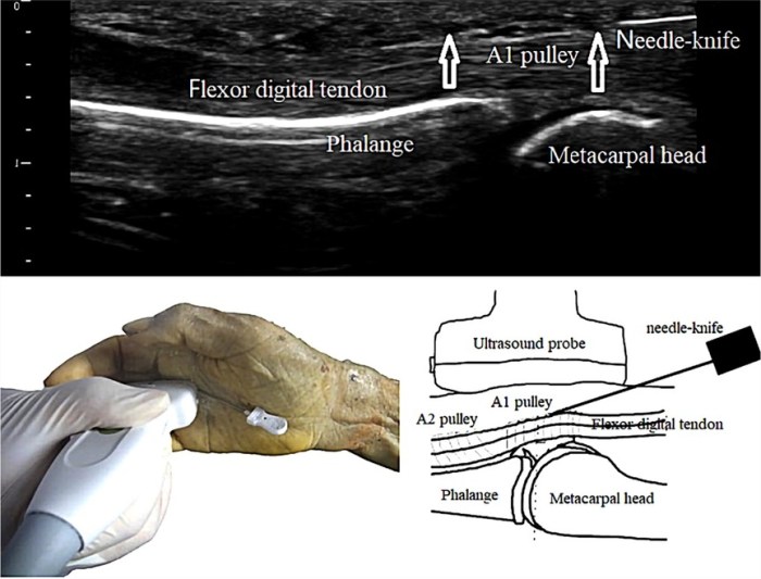 Finger trigger injection treatment hand tendon injections sheath thumb cortisone steroid inject fingers symptoms considerations general tenosynovitis flexor local locking