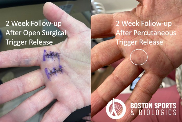 Finger trigger ultrasound release guided percutaneous